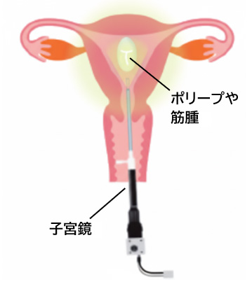 子宮鏡手術